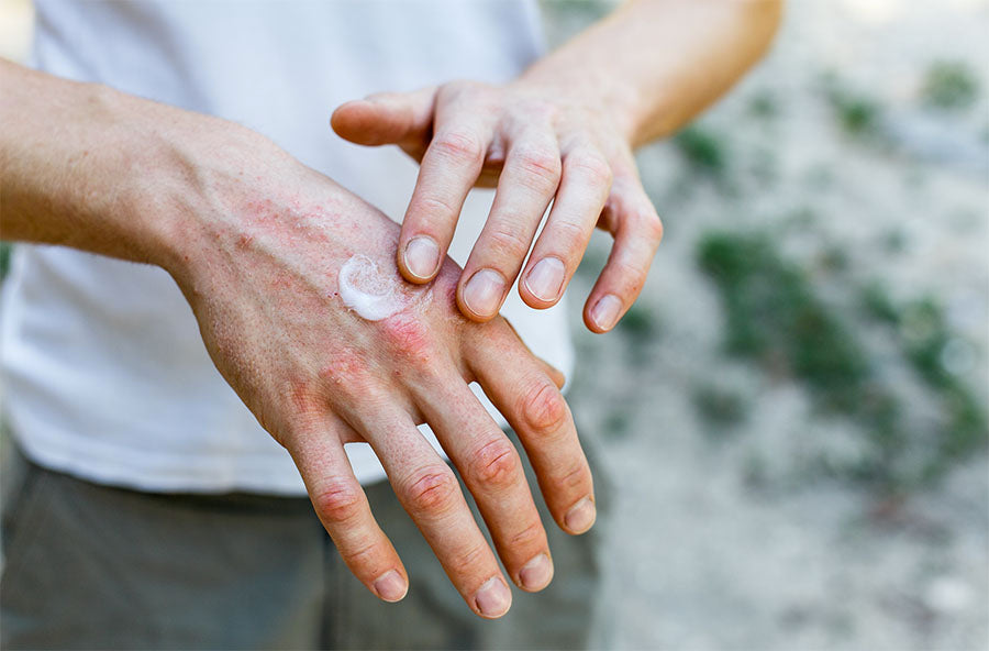 dry cracked skin on top of hands