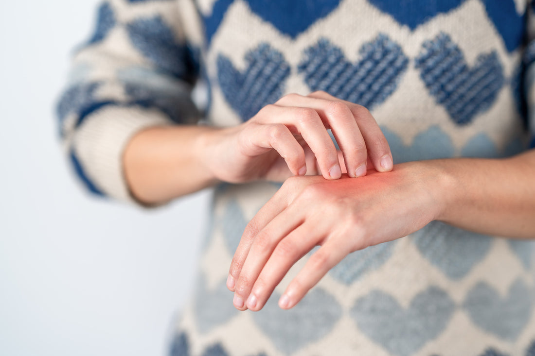 eczema on hands