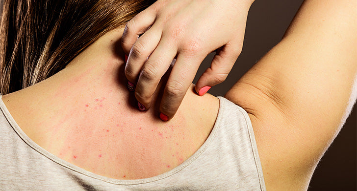 Treatment for Allergic Contact Dermatitis